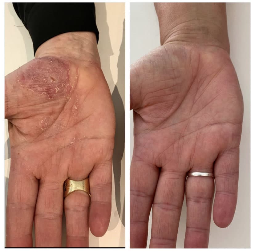 Behandling af Eksem - Hos Klinik MARIANNE BISGAARD