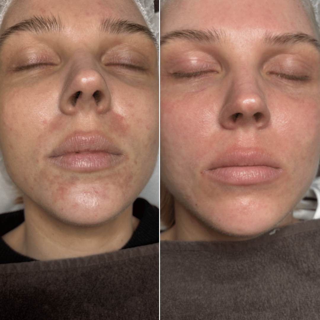 Behandling mod akne og uren hud - Før og efter billede - Hos Klinik Marianne Bisgaard i Vejle