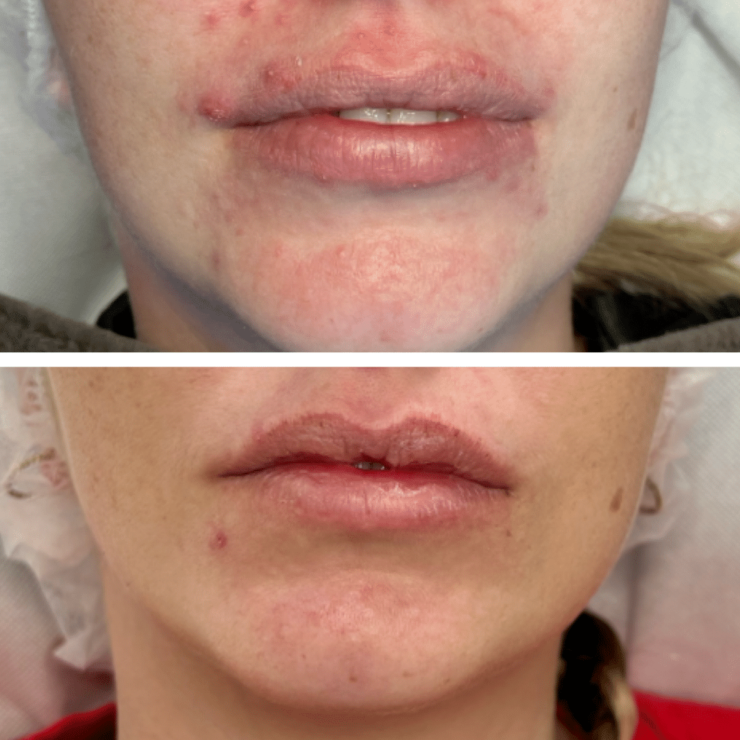 Behandling mod akne og uren hud - Før og efter billede - Hos Klinik Marianne Bisgaard i Vejle
