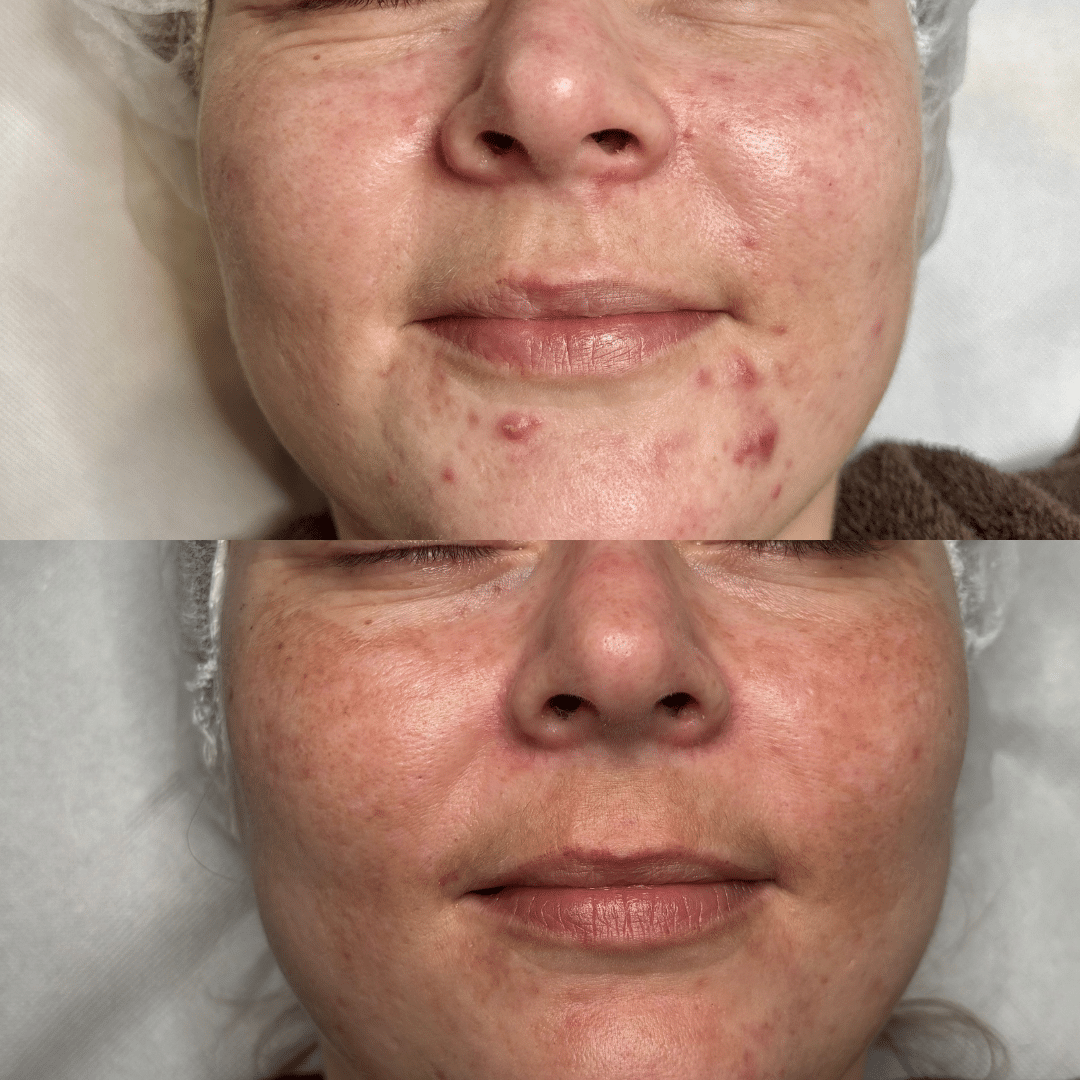 Behandling mod akne og uren hud - Før og efter billede - Hos Klinik Marianne Bisgaard i Vejle