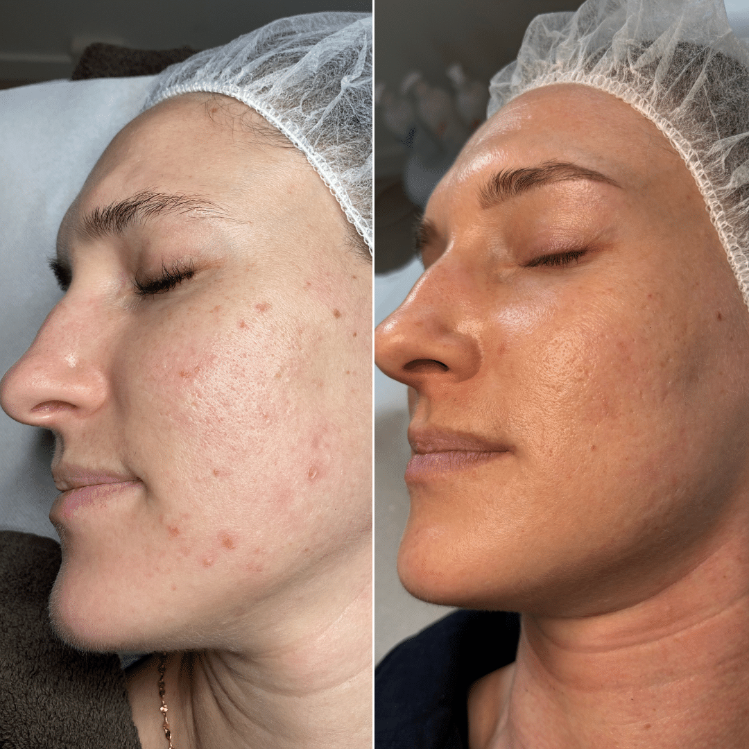 Behandling mod akne og uren hud - Før og efter billede - Hos Klinik Marianne Bisgaard i Vejle