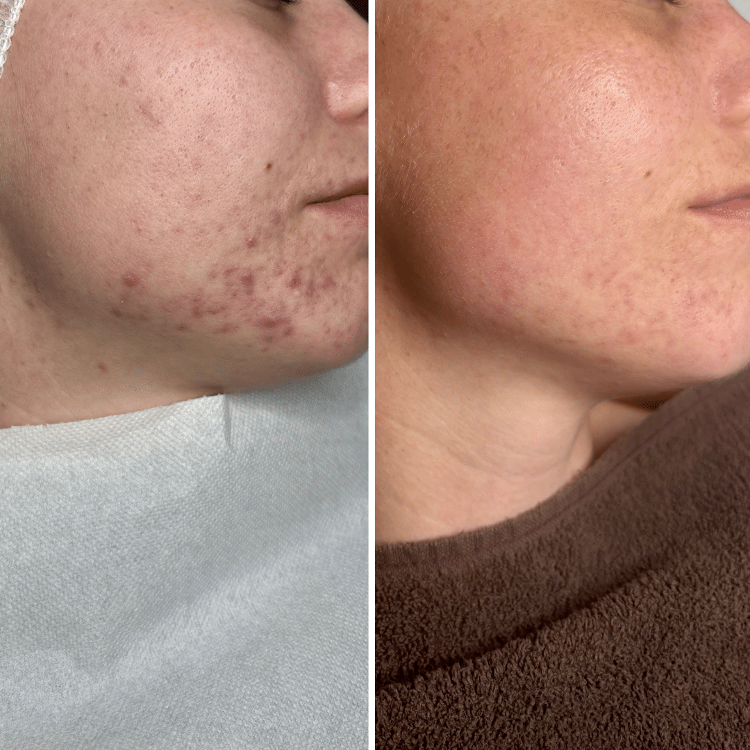 Behandling mod akne og uren hud - Før og efter billede - Hos Klinik Marianne Bisgaard i Vejle