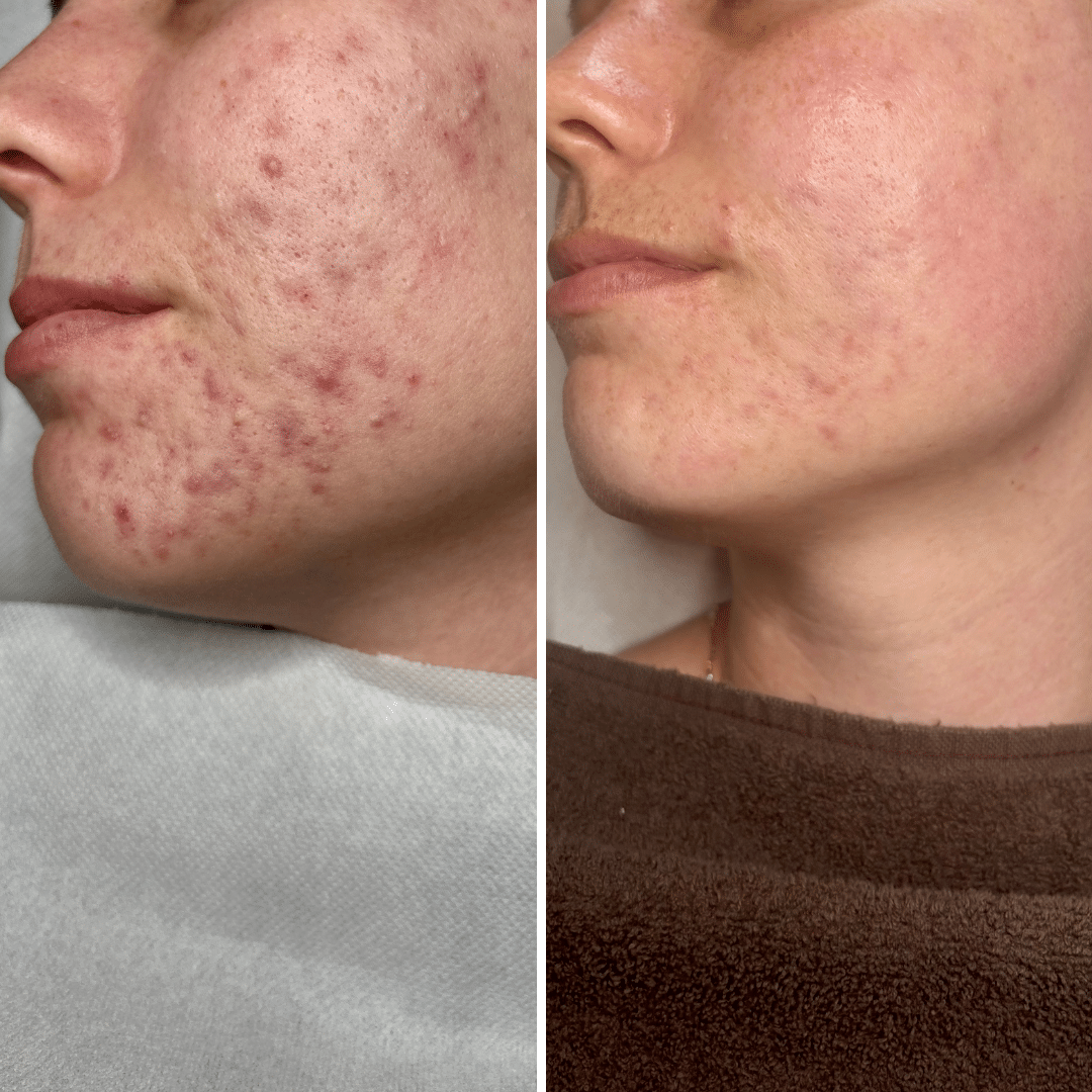 Behandling mod akne og uren hud - Før og efter billede - Hos Klinik Marianne Bisgaard i Vejle