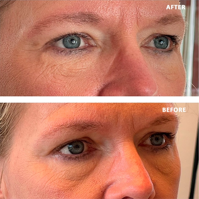 Face Reshape Before After 2