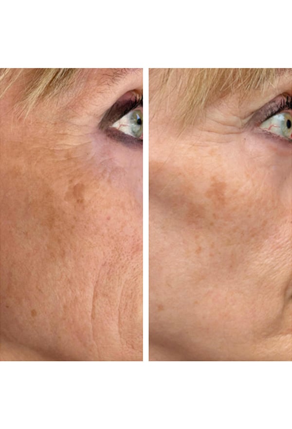 Mesoterapi - Klinik Marianne Bisgaard Vejle