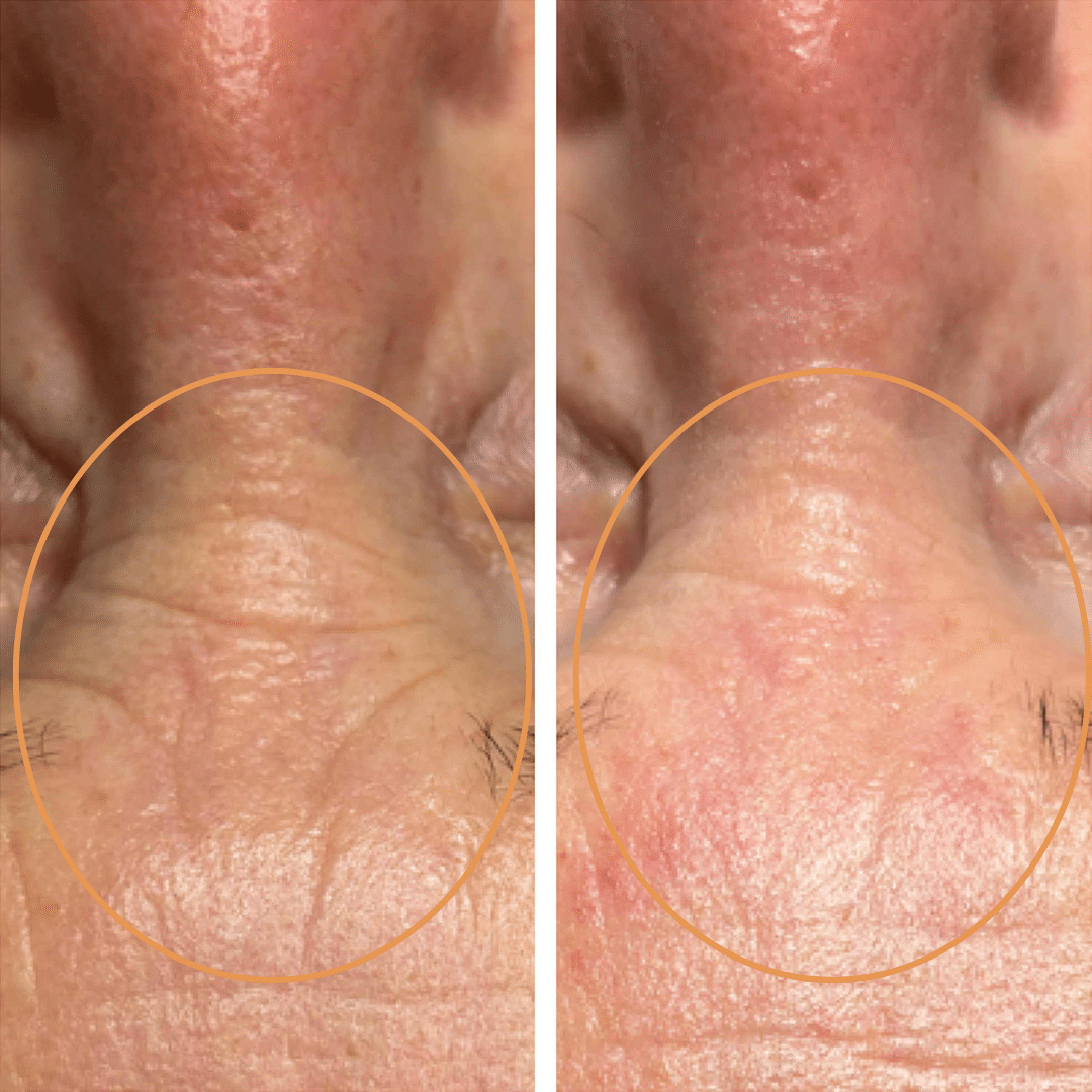 Mesoterapi - Anti-age behandling hos Klinik Marianne Bisgaard