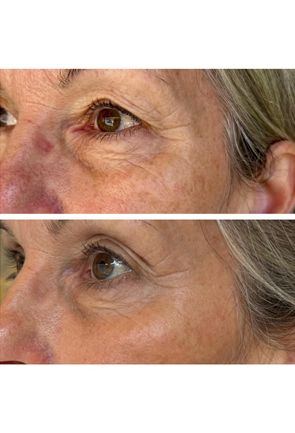 Mesoterapi - Klinik Marianne Bisgaard Vejle