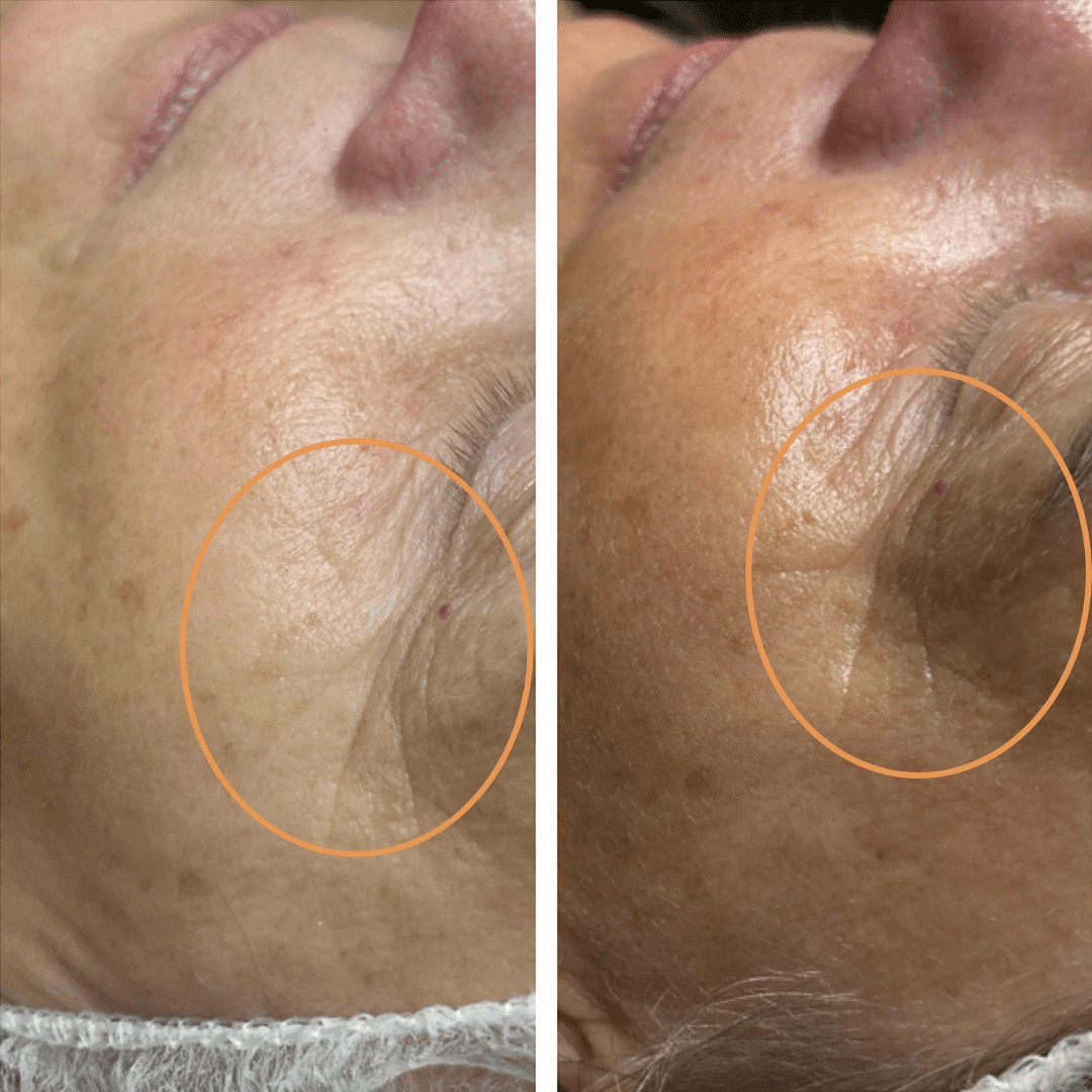 Mesoterapi - Anti-age behandling hos Klinik Marianne Bisgaard