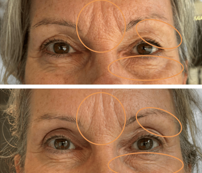 Mesoterapi - Anti-age behandling hos Klinik Marianne Bisgaard