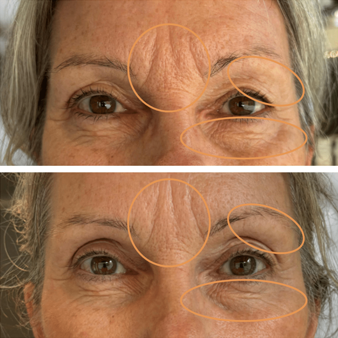 Mesoterapi - Anti-age behandling hos Klinik Marianne Bisgaard