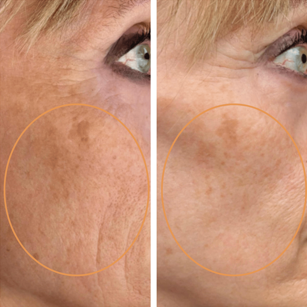 Mesoterapi - Anti-age behandling hos Klinik Marianne Bisgaard