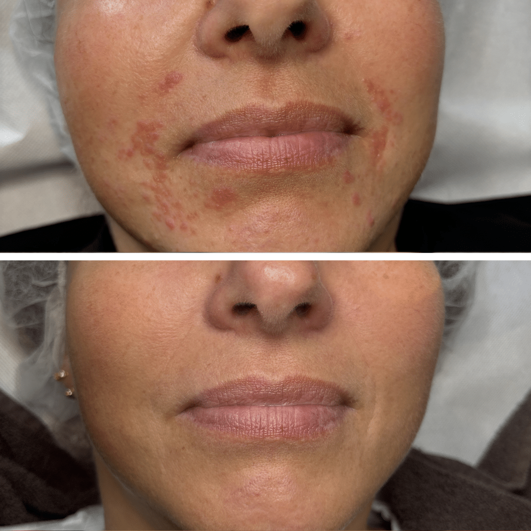 Perioral dermatitis - Behandling hos Klinik Marianne Bisgaard i Vejle