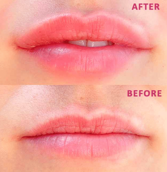 MESO LIP BILLEDE AF LÆBER FØR OG EFTER