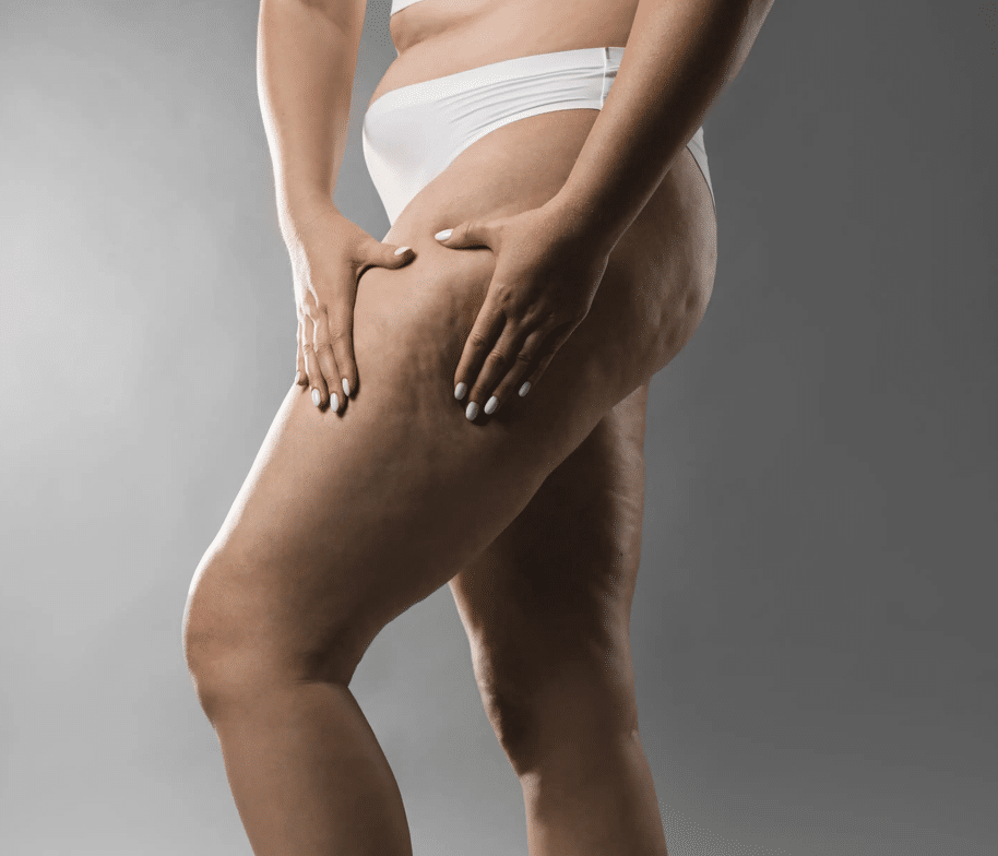 Behandling mod Appelsinhud