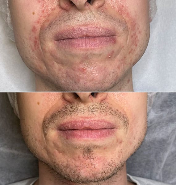 Perioral dermatitis og mænd