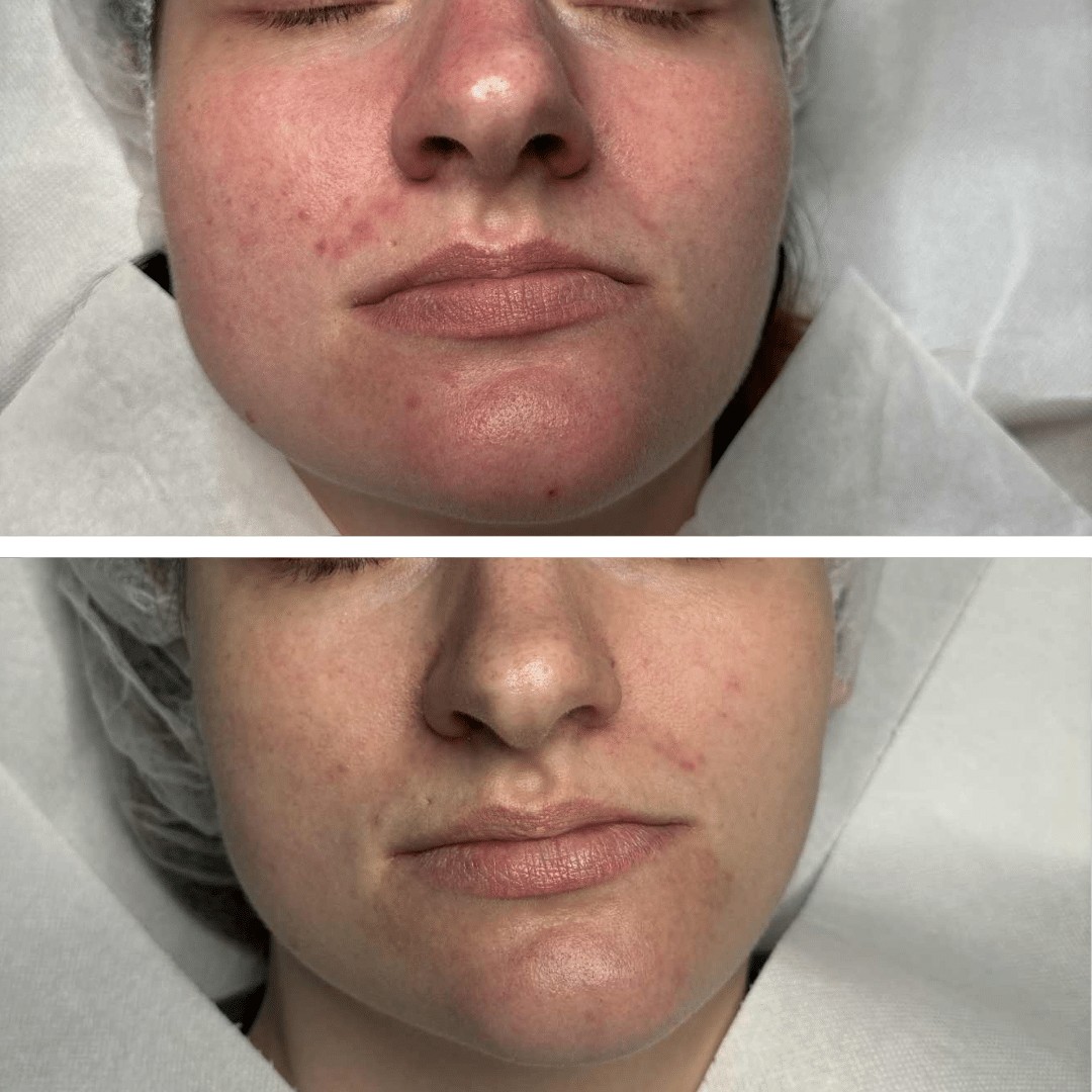 Behandling af Perioral dermatitis - Hos Klinik Marianne Bisgaard i Vejle