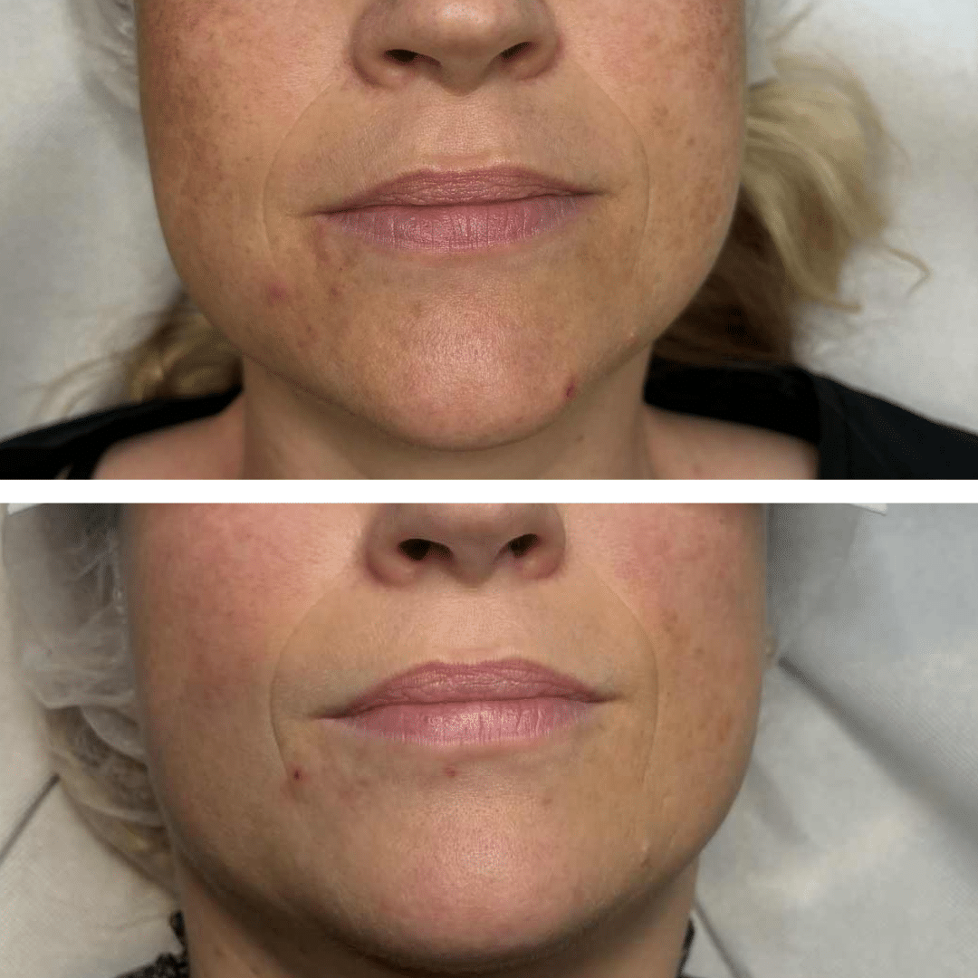 Behandling af Perioral dermatitis - Hos Klinik Marianne Bisgaard i Vejle