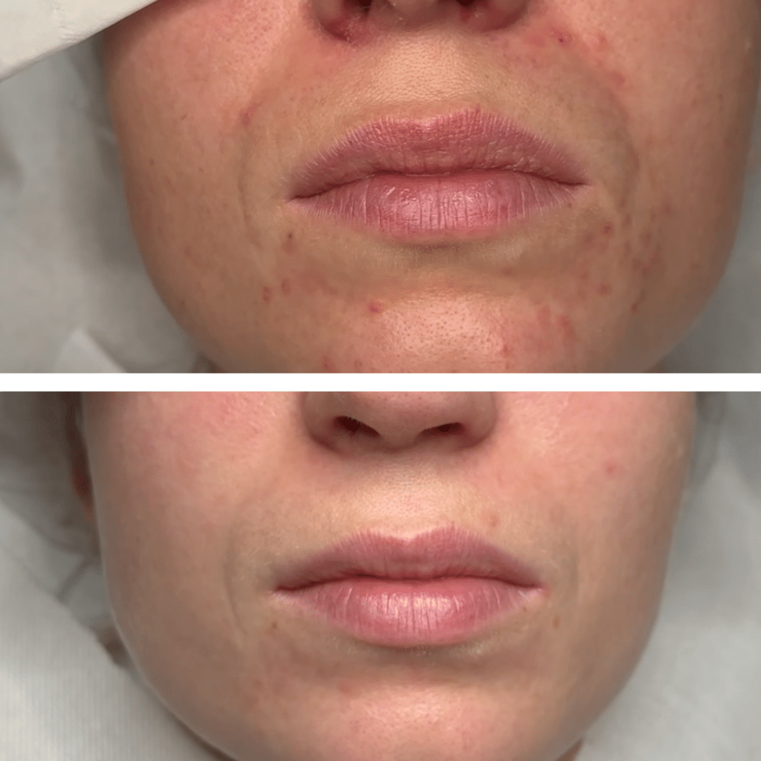 Før og efter behandlingsforløb mod perioral dermatitis med tydelig forbedring af rødme og hudstruktur omkring munden.