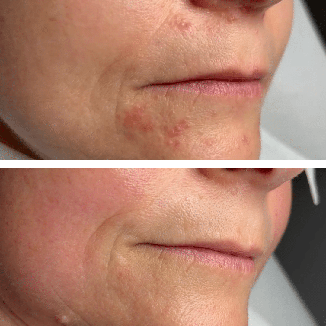 Før og efter behandlingsforløb mod perioral dermatitis med tydelig forbedring af rødme og hudstruktur omkring munden.