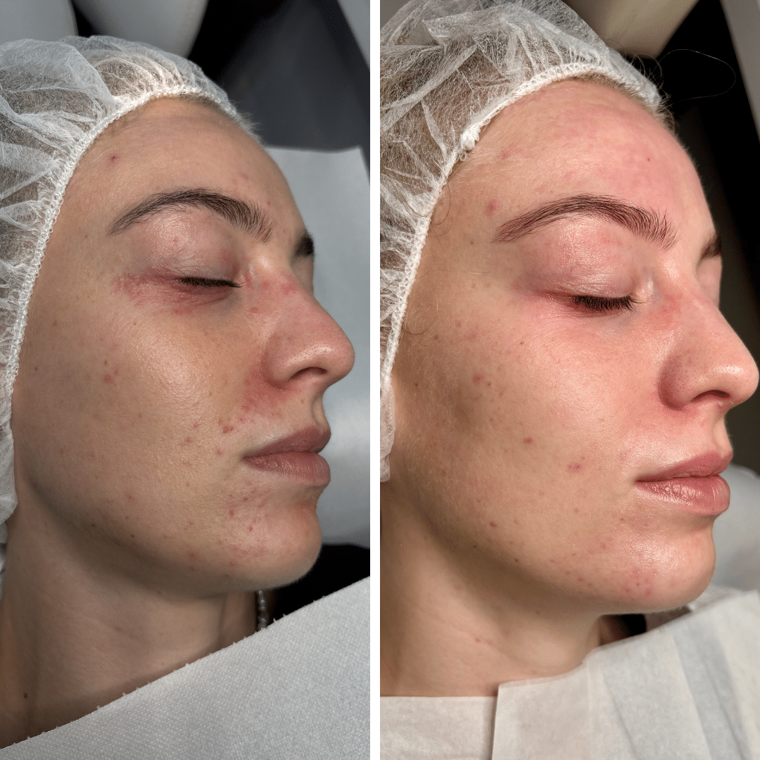 Før og efter behandlingsforløb mod perioral dermatitis med tydelig forbedring af rødme og hudstruktur omkring munden.