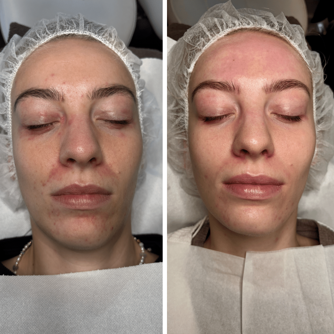 Før og efter behandlingsforløb mod perioral dermatitis med tydelig forbedring af rødme og hudstruktur omkring munden.