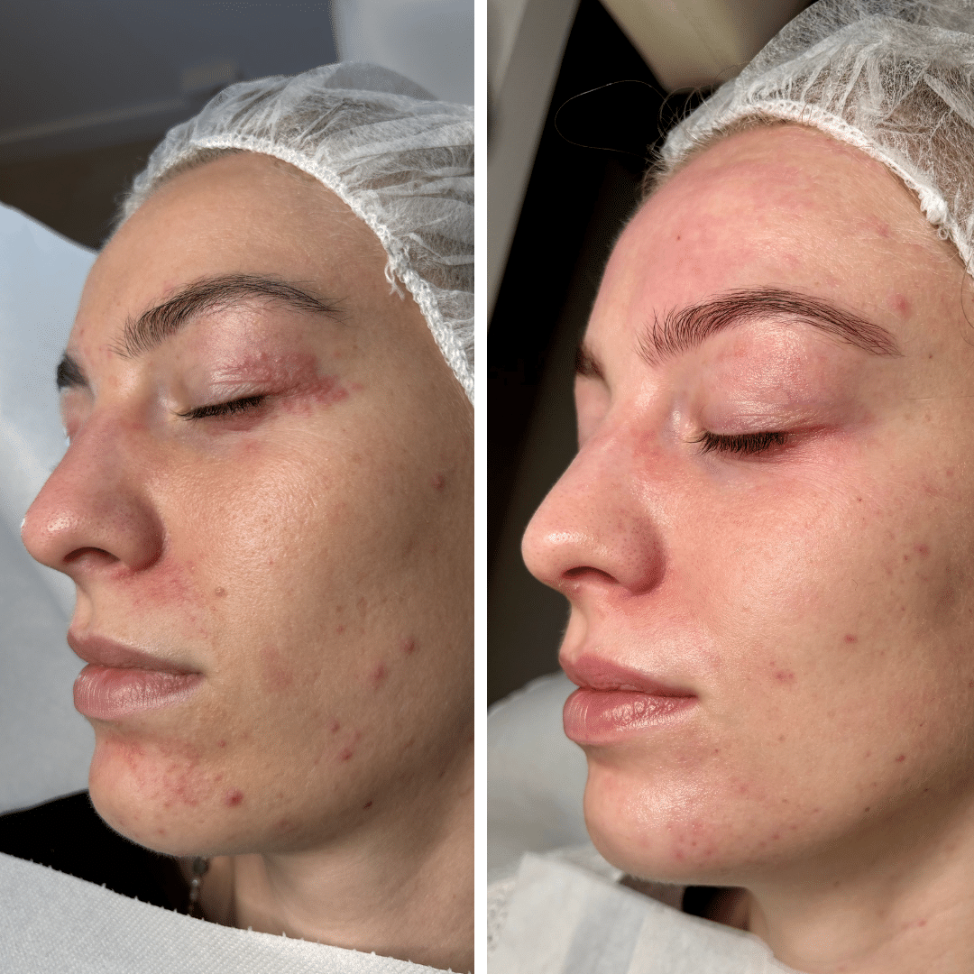 Før og efter behandlingsforløb mod perioral dermatitis med tydelig forbedring af rødme og hudstruktur omkring munden.