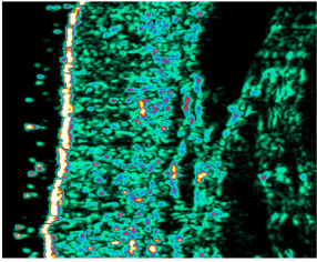 Ultralydsscanning - Ultralydsscanning af venstre tinding før<br />