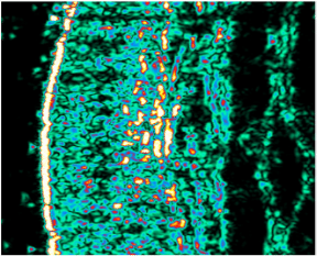 Ultralydsscanning af venstre tinding efter 12 uger<br />