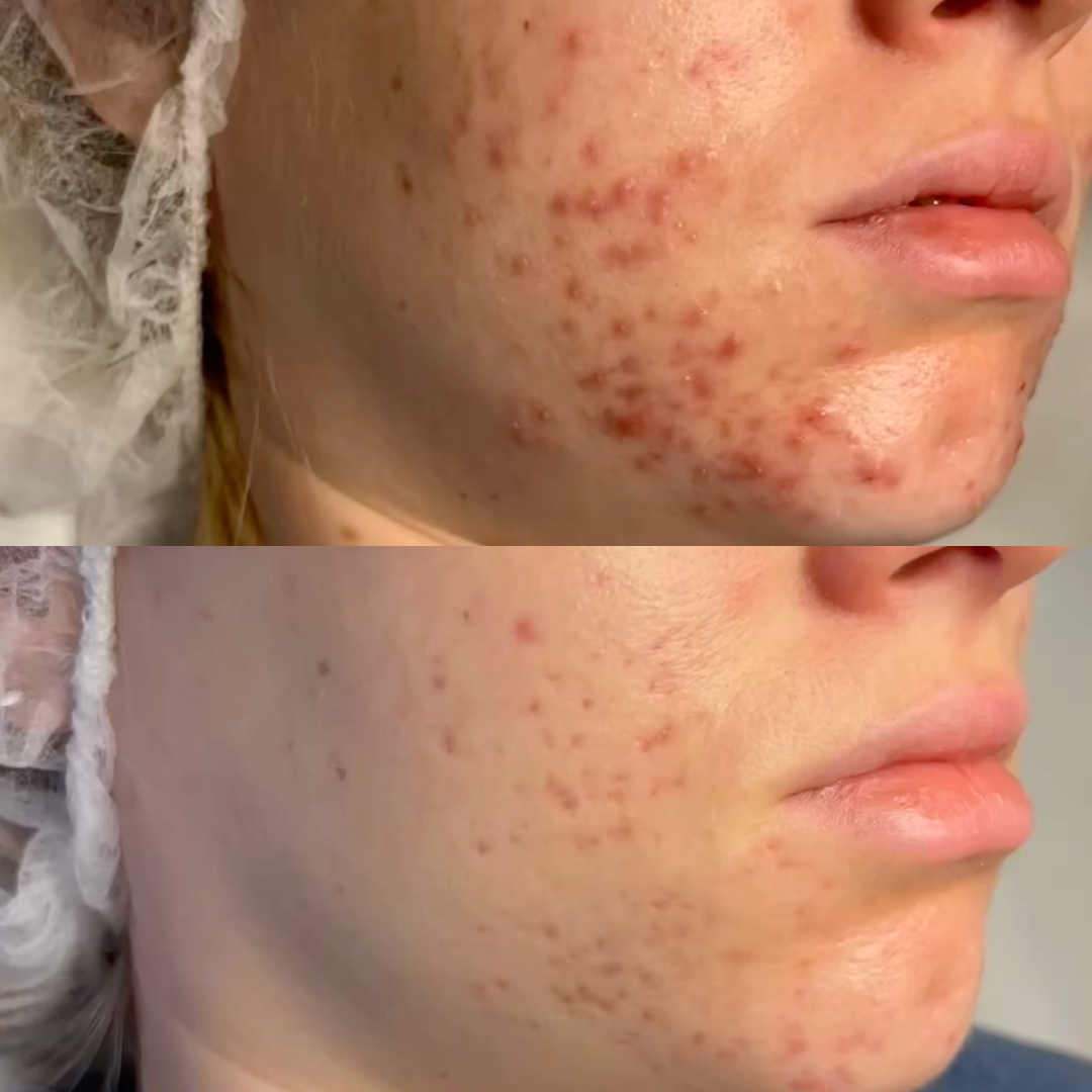 Perioral dermatitis