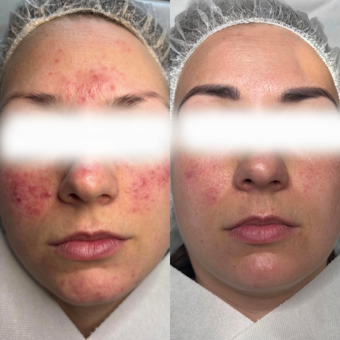 Perioral dermatitis