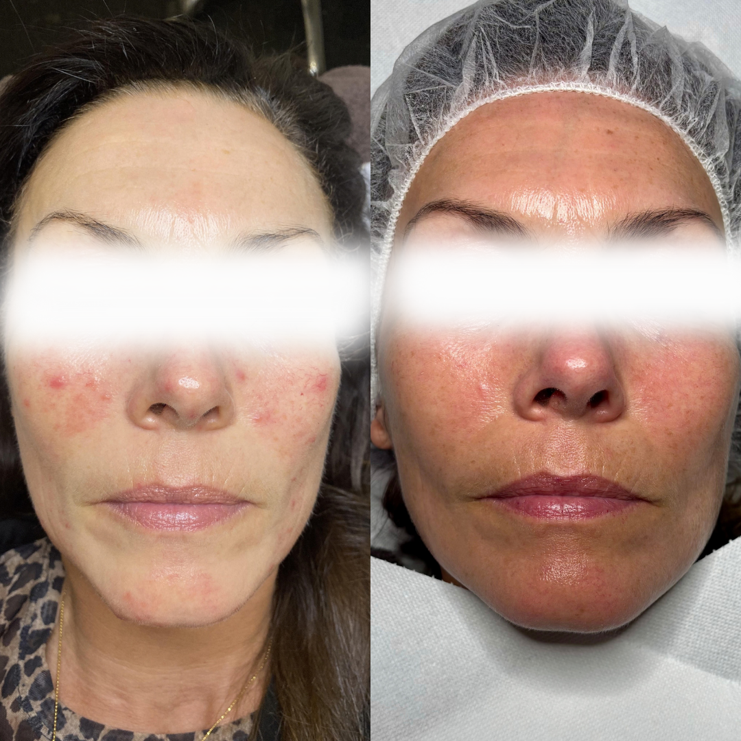 Resultat af kurforløb mod Rosacea - Klinik Marianne Bisgaard