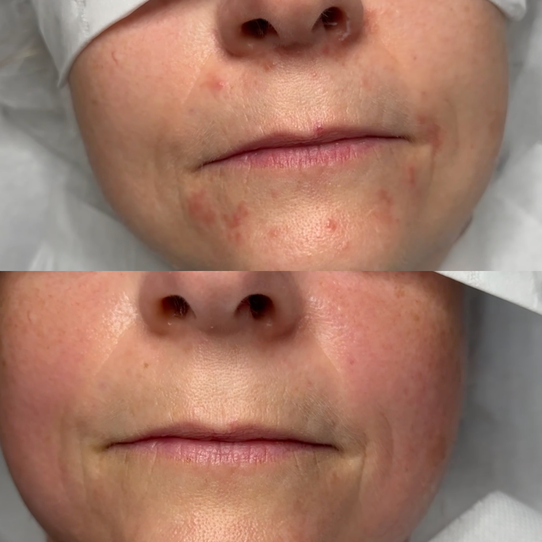 Resultat af kurforløb mod Perioral dermatitis - Klinik Marianne Bisgaard Resultat efter endt kurforløb mod Perioral dermatitis