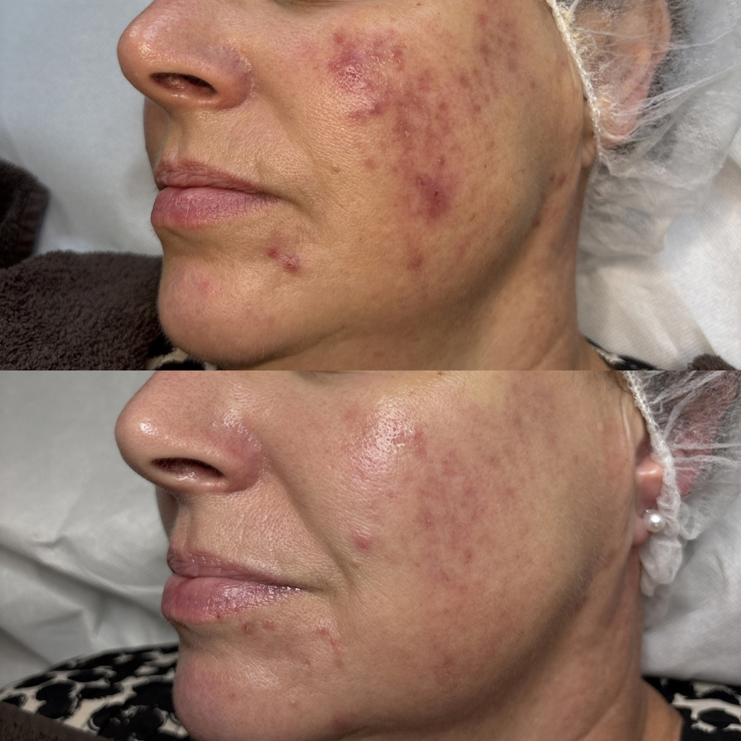 Resultat af kurforløb mod Perioral dermatitis - Klinik Marianne Bisgaard