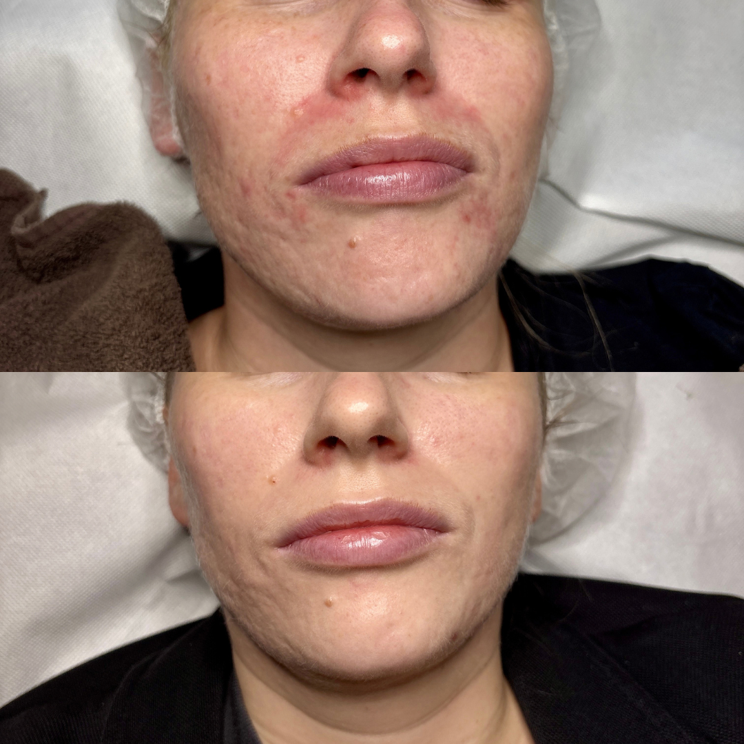 Resultat af kurforløb mod Perioral dermatitis - Klinik Marianne Bisgaard Resultat af kurforløb mod Perioral dermatitis - Klinik Marianne Bisgaard