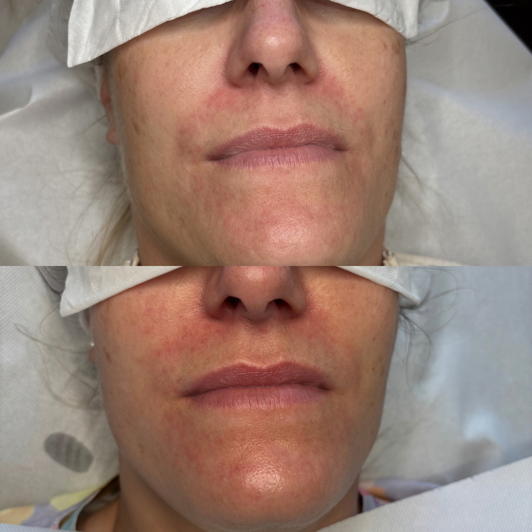 Resultat af kurforløb mod Perioral dermatitis - Klinik Marianne Bisgaard Perioral dermatitis
