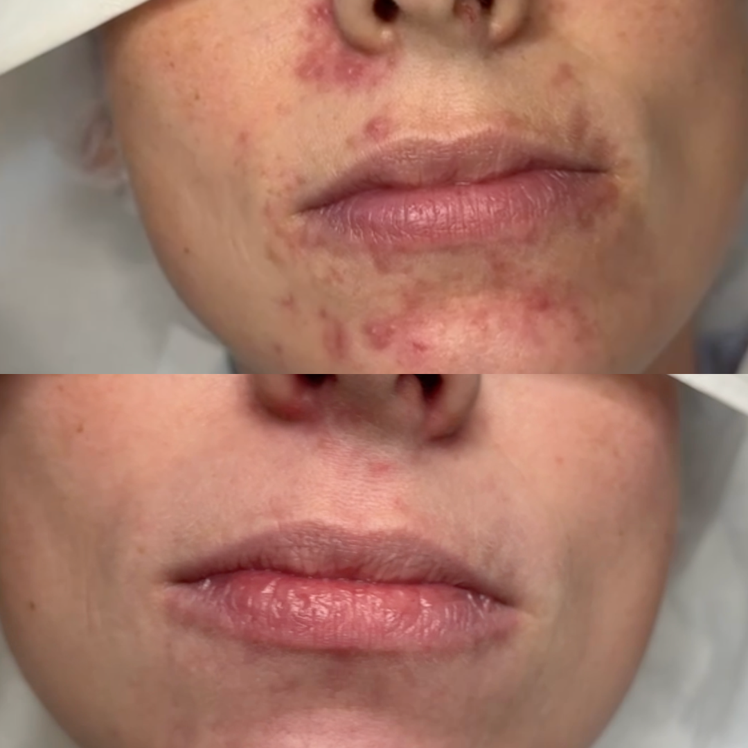 Perioral dermatitis