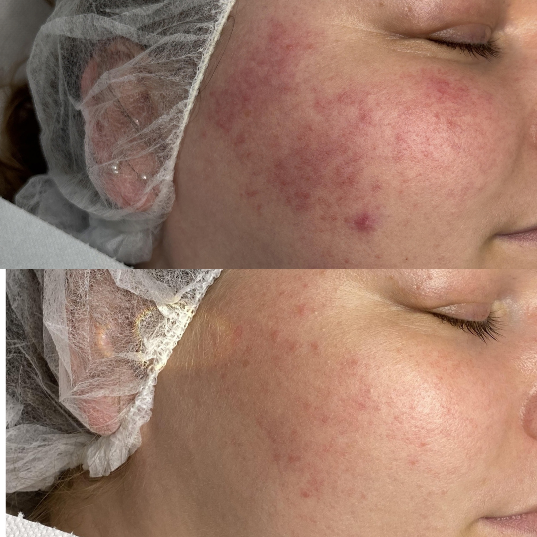 Resultat af kurforløb mod Rosacea - Klinik Marianne Bisgaard