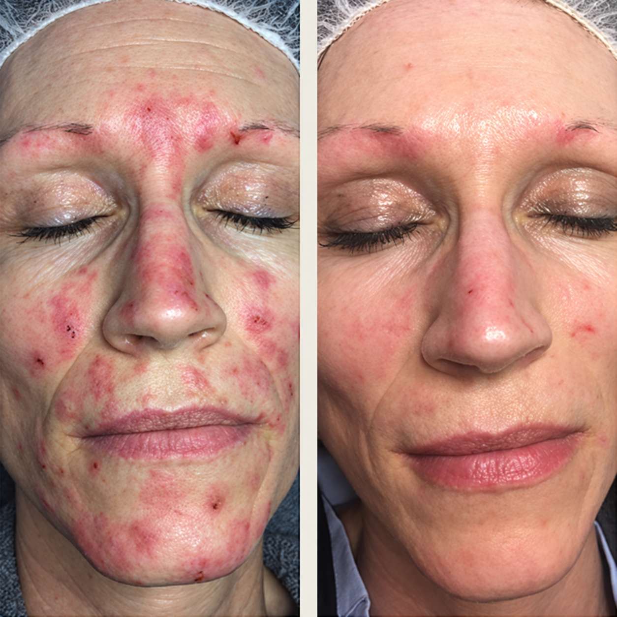 Rosacea - hudproblem Rosacea - Før & efter billede behandling